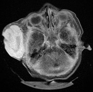 大型血管瘤的MRI诊断(横向)